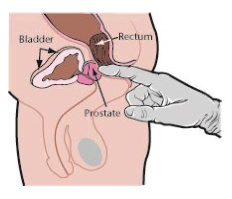 avoid prostate cancer